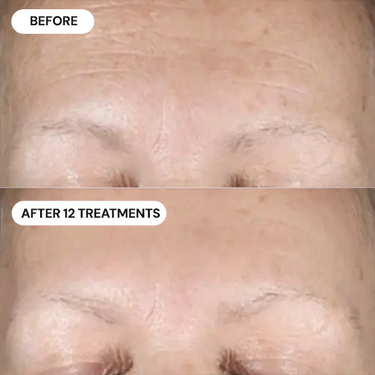 Forehead Wrinkles & Frown Lines