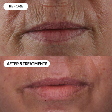 Reduced "Smoker's lines"