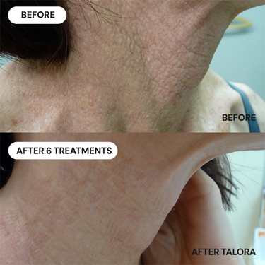 Lifts and Firms Sagging Neck